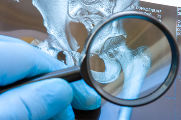 Hip Impingement: Cam & Pincer Lesions Causes & Symptoms
