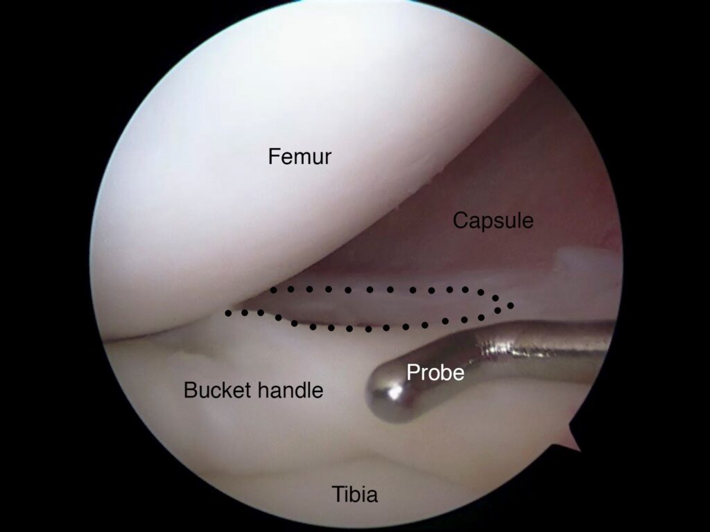 Arthroscopic view of a knee showing a bucket-handle tear in the meniscus between the femur and tibia, with a probe nearby.