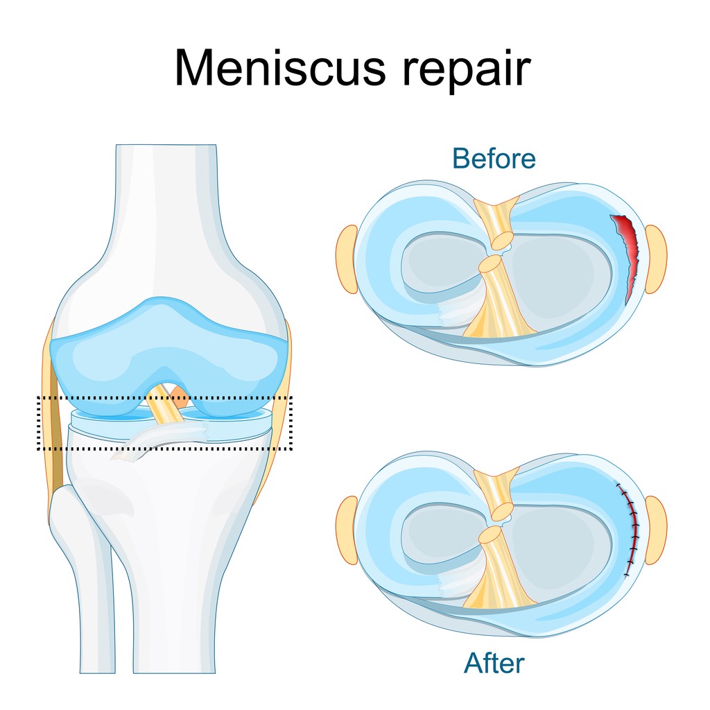 Knee joint diagram showing meniscus repair with sutures, before and after views of a torn meniscus being repaired