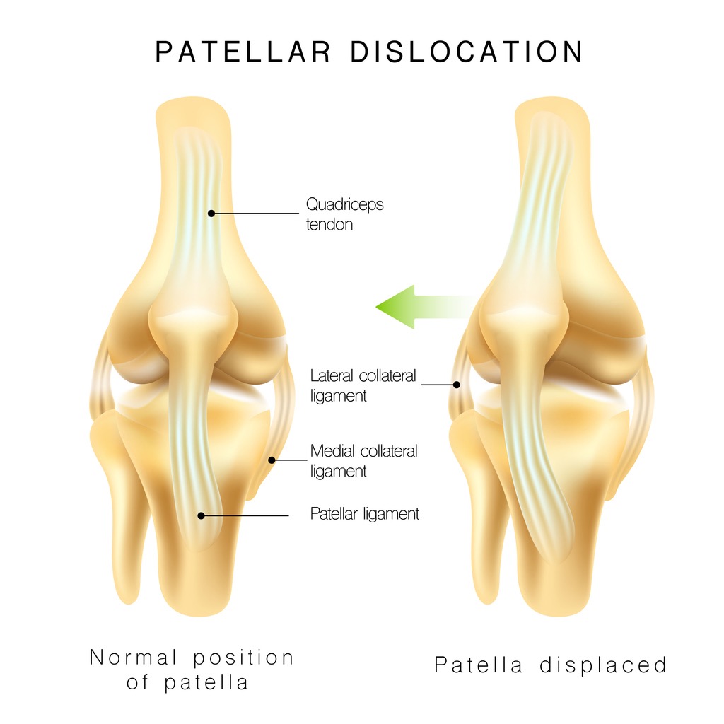 Diagram showing normal knee anatomy vs patella dislocation with labeled ligaments: quadriceps tendon, lateral and medial collateral ligaments, patellar ligament, highlighting outward movement of the patella on the right side.