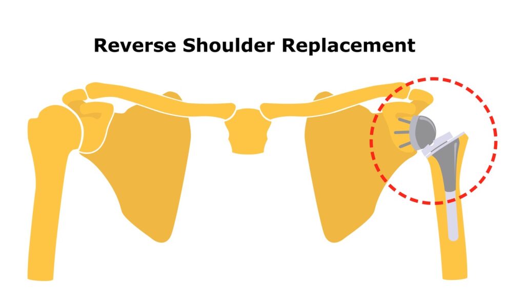Illustration of a reverse shoulder replacement: a prosthetic joint attached to the right shoulder circled in red on a yellow skeleton image