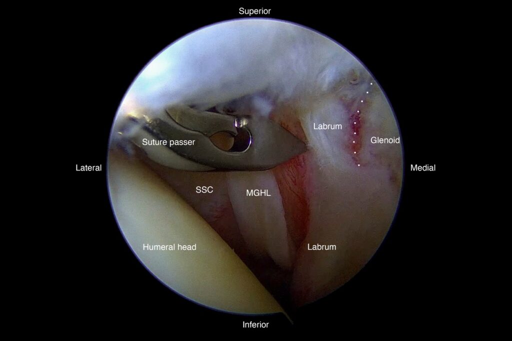 Arthroscopic view of the shoulder with a suture passer near the labrum and glenoid surface.
