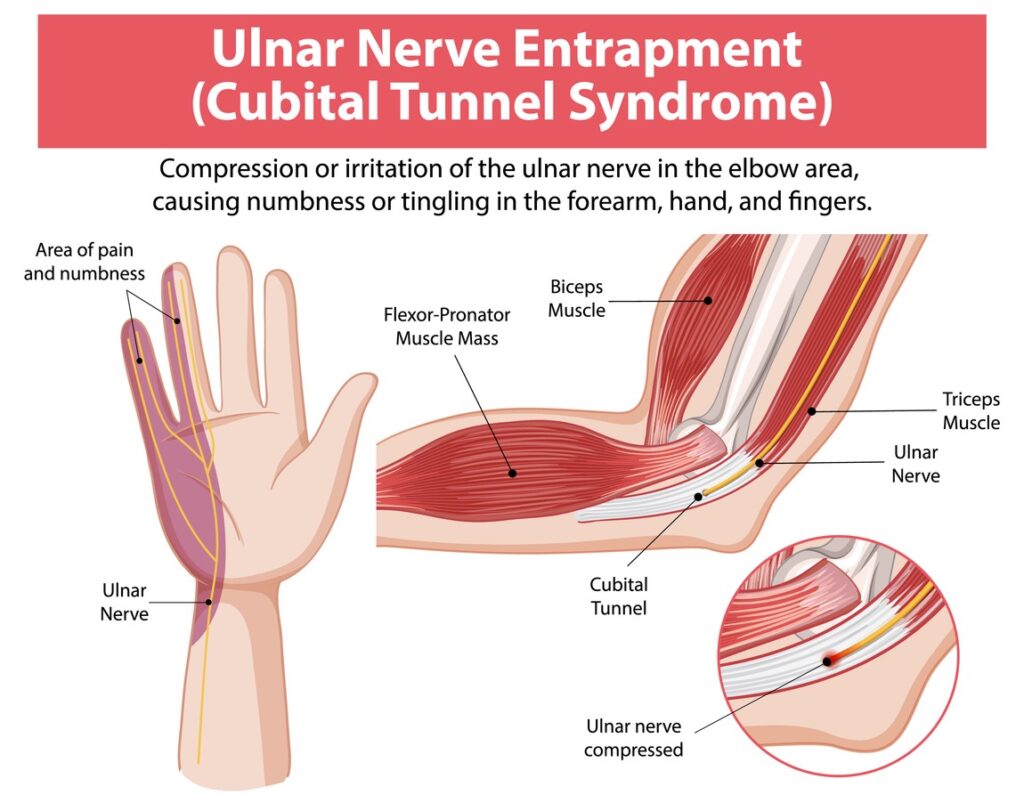 An anatomy diagram showing the ulnar nerve path from elbow to hand, highlighting cubital tunnel compression (cubital tunnel syndrome) with labeled arm muscles and images of numbness areas in the forearm and hand.
